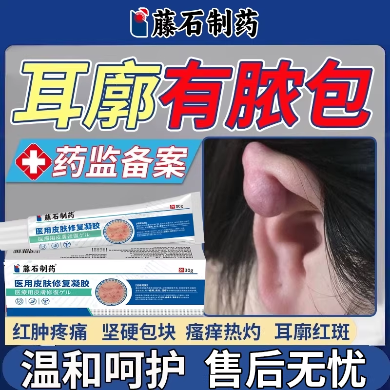 外耳廓假性囊肿夹子耳朵疖肿胀有硬块肿瘤皮脂腺消软骨膜炎增生EM