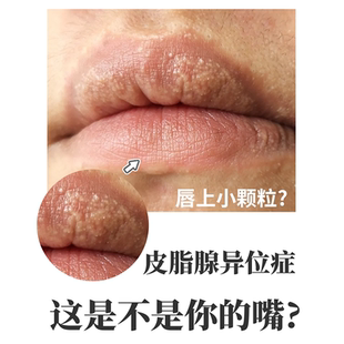 皮脂腺异位症嘴唇白点脂肪小颗粒增生嘴皮干燥起皮药房同款膏JW