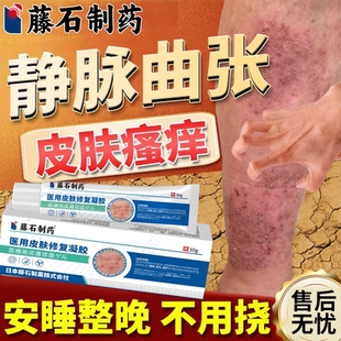 静脉曲张皮肤瘙痒症专用小腿止痒膏用什么冷敷凝胶可搭药监备案EM