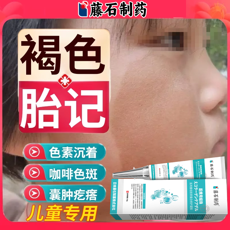 儿童胎记去除点斑膏神经纤维瘤药贴皮肤牛奶咖啡斑药房同款膏水EM