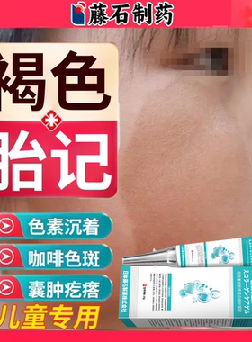 儿童胎记去除点斑膏神经纤维瘤药贴皮肤牛奶咖啡斑药房同款膏水EM