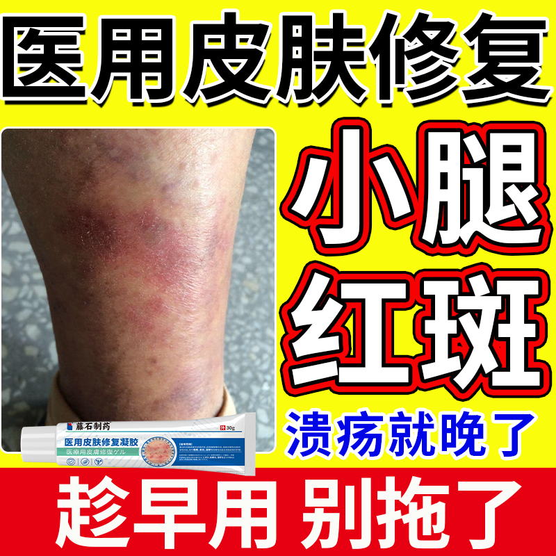 小腿红斑】淤积性皮炎趁早用别拖