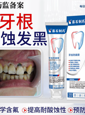 牙齿酸蚀牙根腐蚀变黑脱矿釉质楔状缺损修黑斑去除复含氟搭牙膏JW