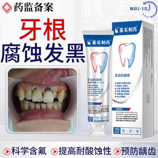 牙齿酸蚀牙根腐蚀变黑脱矿釉质楔状缺损修黑斑去除复含氟搭牙膏JW