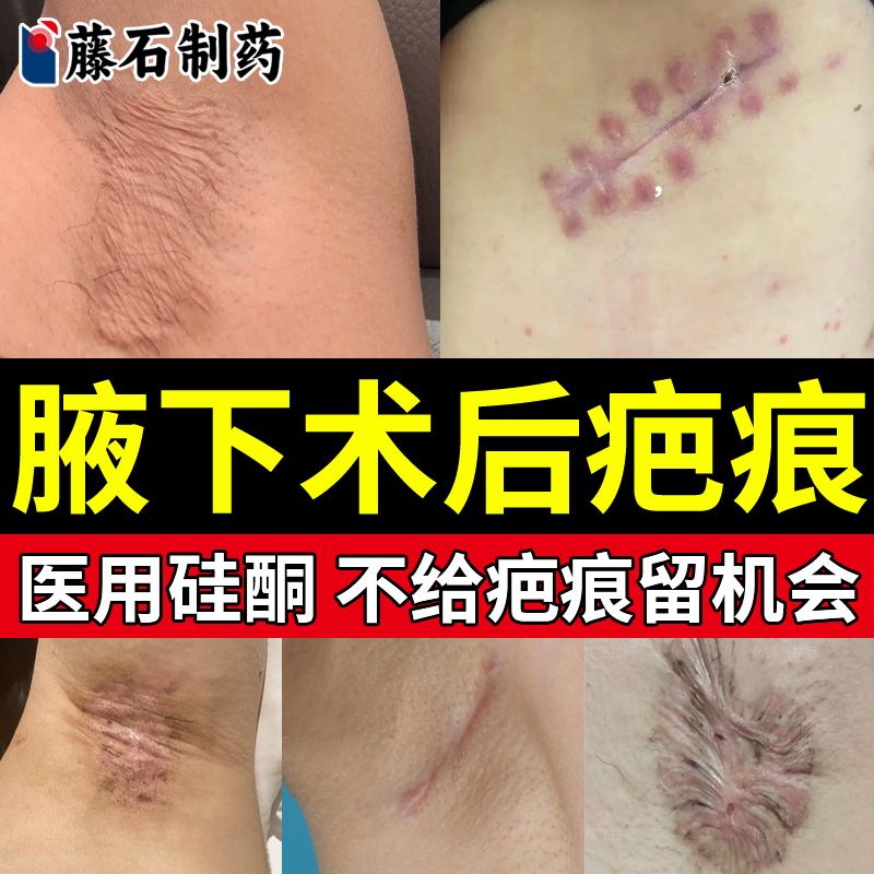 【医用硅酮】腋下疤痕祛疤膏