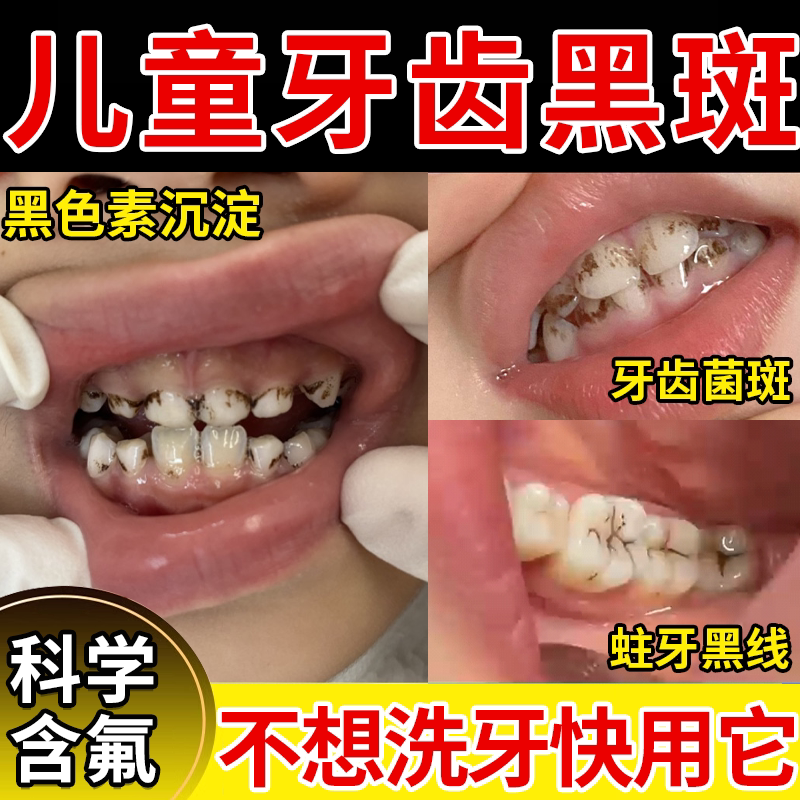 儿童牙齿黑斑菌斑黑色素沉淀去除非牙膏护牙素含氟黑牙祛除神器JW