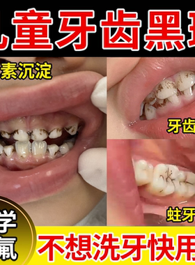 儿童牙齿黑斑菌斑黑色素沉淀去除非牙膏护牙素含氟黑牙祛除神器JW