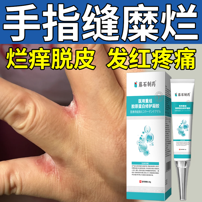 手指缝溃烂洗碗烂手丫软膏专用烂痒脱皮水泡手癣手气药房同款膏JW