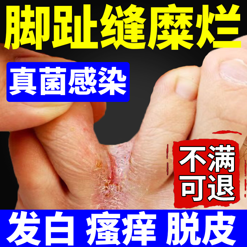 【不满可退】脚气脚趾缝糜烂