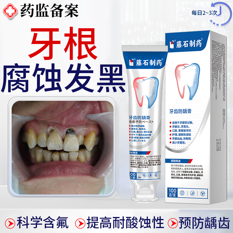牙齿酸蚀牙根腐蚀变黑脱矿釉质楔状缺损修黑斑去除复含氟搭牙膏JW