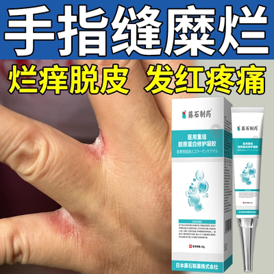 【现货速发】手指缝溃烂手丫软膏