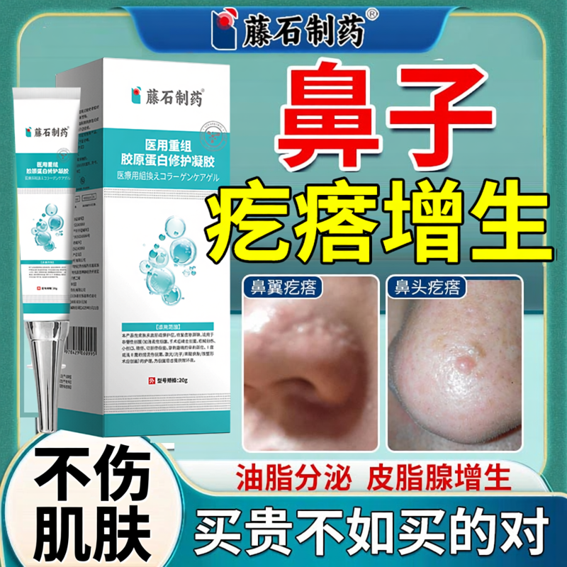 鼻子上小肉疙瘩鼻翼鼻头增生皮脂腺增生痘疤凸起酒糟鼻脸上肉粒OZ