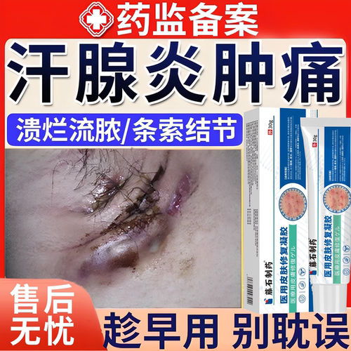 【藤石制药】汗腺炎红肿疼流脓膏