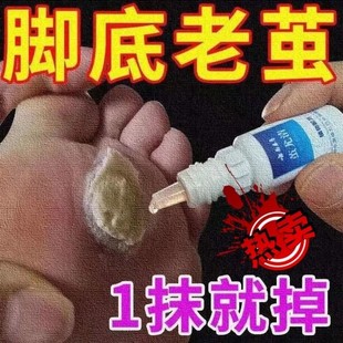 云南本草茧尤清脚底老茧手茧祛去除茧子膏专用神器死皮软化剂手脚