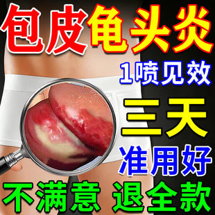 包皮炎症特效膏药治疗男性包皮裂口龟头发炎珍珠状丘疹专用清洗液