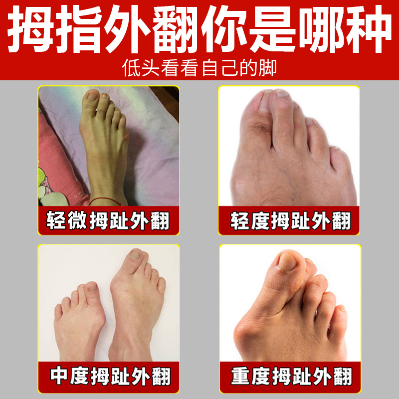 拇外翻贴大脚趾拇外翻器脚趾变形重叠大脚骨外露专用冷敷凝胶