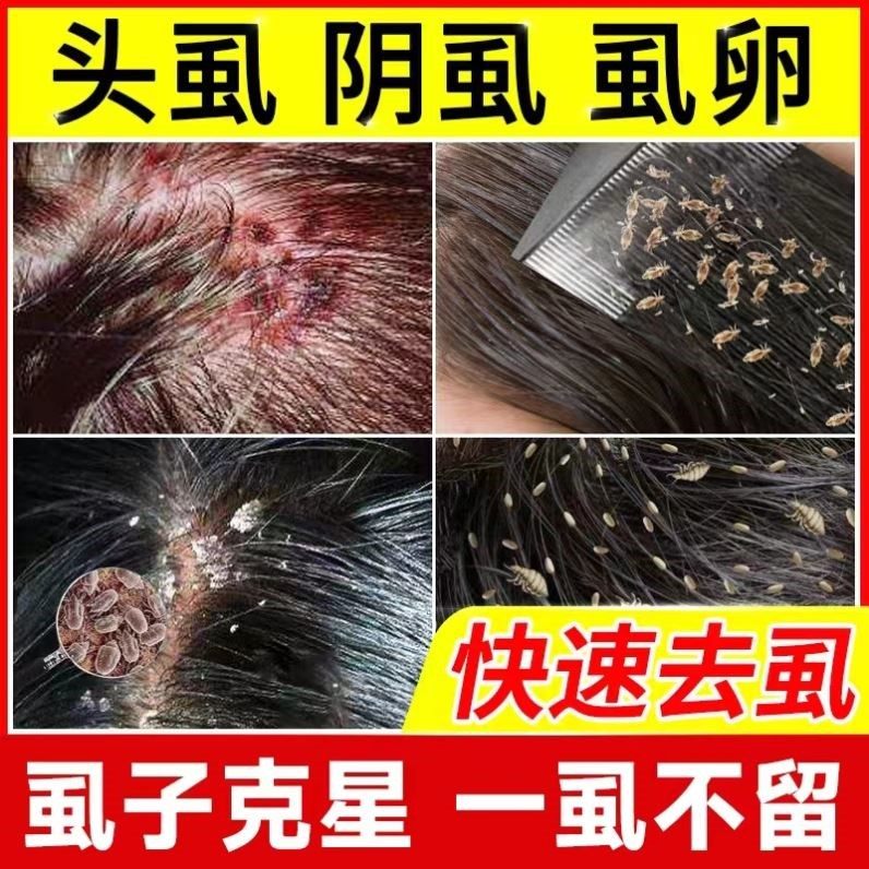 儿童头上虱子药祛头虱净去卵虮螨虫洗发水阴虱除虱喷剂液体