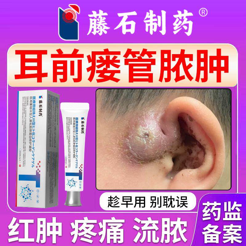 耳前瘘管耳仓流脓真菌感染药监备案可搭清理工具防水贴膏PG