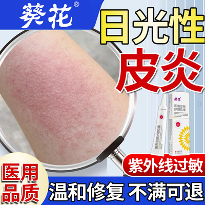日光性皮炎紫外线过敏修复