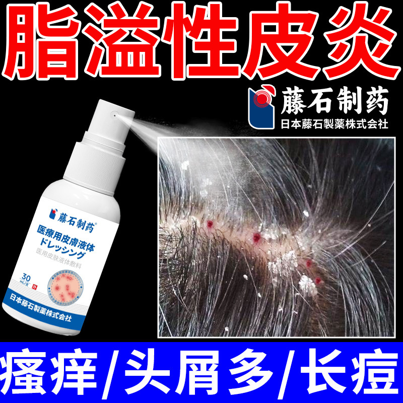 脂溢性皮炎头部喷剂止痒头屑头痒专用真菌感染头皮癣毛囊炎喷雾QY
