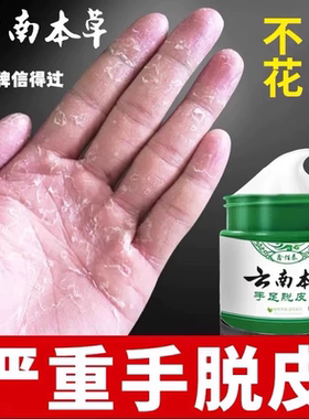 手足脱皮膏手指上真菌蜕皮干燥起皮童手掌蜕皮手心手脚掉皮褪专用