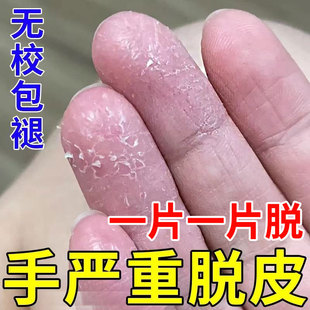 手足脱皮膏手指上真菌蜕皮干燥起皮童手掌蜕皮手心手脚掉皮褪专用