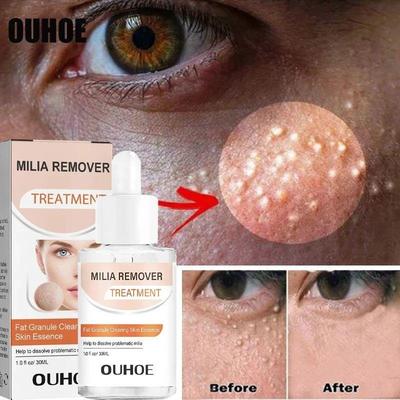 Fat Granules Removal Eye Serum Anti Dark Circle Eye Bags