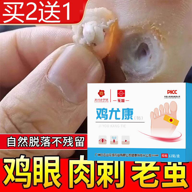 鸡尤康贴去除肉刺扁平疣瘊子鸡眼