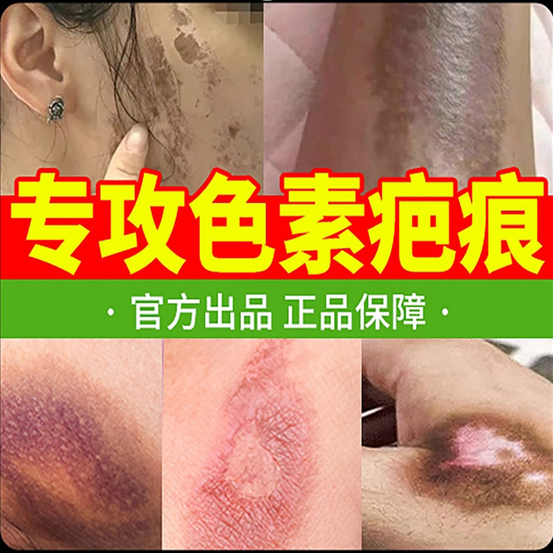 第一名祛疤膏去除淡化黑印黑色素