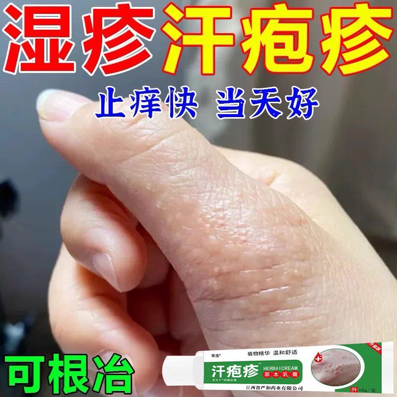 汗泡软膏药膏手上起小水泡孢疹汗状疱疹专用真菌止痒汉感染癣湿疹