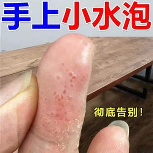 汗泡软膏药膏手上起小水泡孢疹汗状疱疹专用真菌止痒汉感染癣湿疹