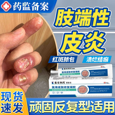 肢端性皮炎脓包糜烂脱皮专用膏
