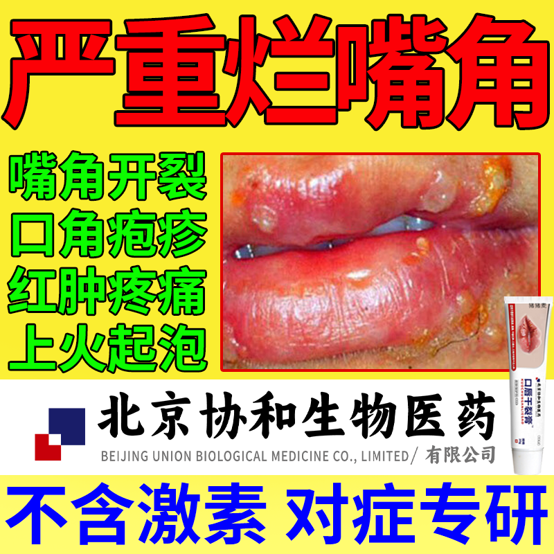 口角炎嘴角开裂烂嘴角药膏嘴巴上火起泡口周皮炎唇周炎唇膏医用oz