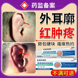 外耳廓假性囊肿夹子耳朵疖肿胀有硬块肿瘤皮脂腺消软骨膜炎增生EM