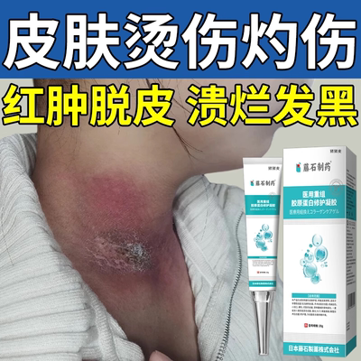 皮肤烫伤灼伤防护凝胶