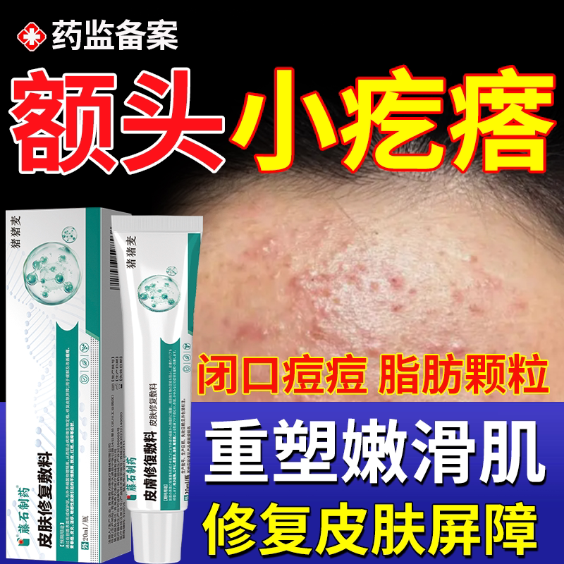 额头痘痘闭口粉刺额头上起小疙瘩的克去除脸部星脂肪粒药房款膏OZ