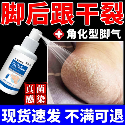 【不满可退】脚后跟干裂真菌感染