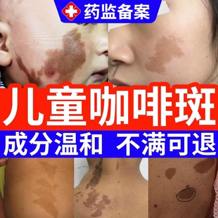儿童胎记点斑神经纤维瘤膏贴皮肤牛奶咖啡斑药房同款膏水EM