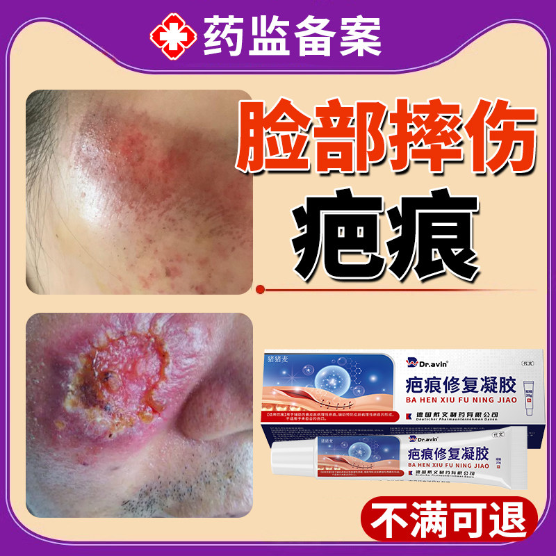 医用摔伤祛疤膏擦伤疤痕修复产品去疤痕除疤膏非第一名专用脸部DZ