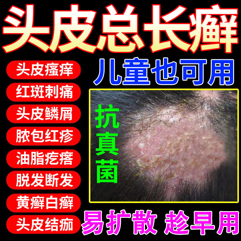 头癣专用头皮癣脂溢性皮炎银屑病特效头部瘙痒克星真菌感染药膏JW