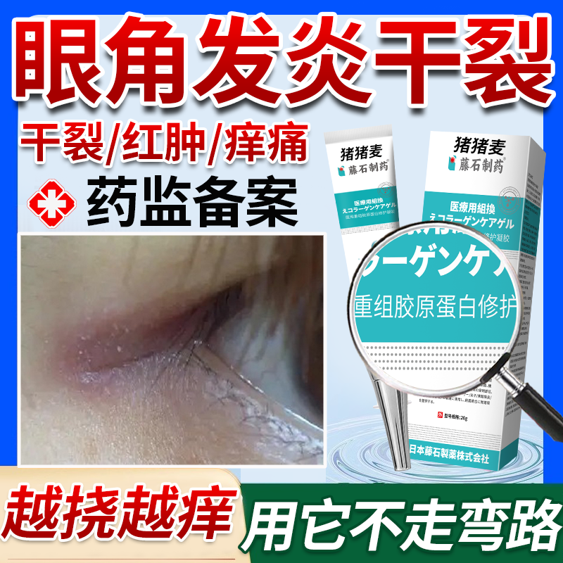 眼角发炎干裂】直击根源不走弯路