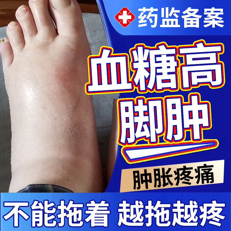 血糖高型老人脚肿消肿搭膏药贴专用去大小腿下肢浮肿水肿的喷剂OZ