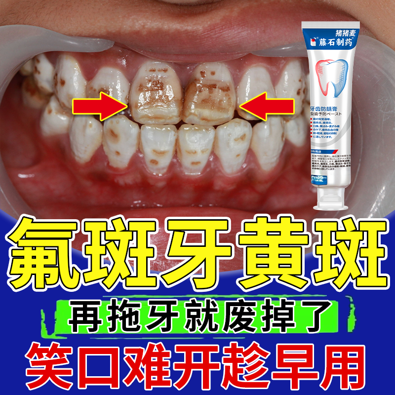 氟斑牙去除可搭专用牙膏脱矿白斑变白神器儿童美白稀盐酸擦剂OZ