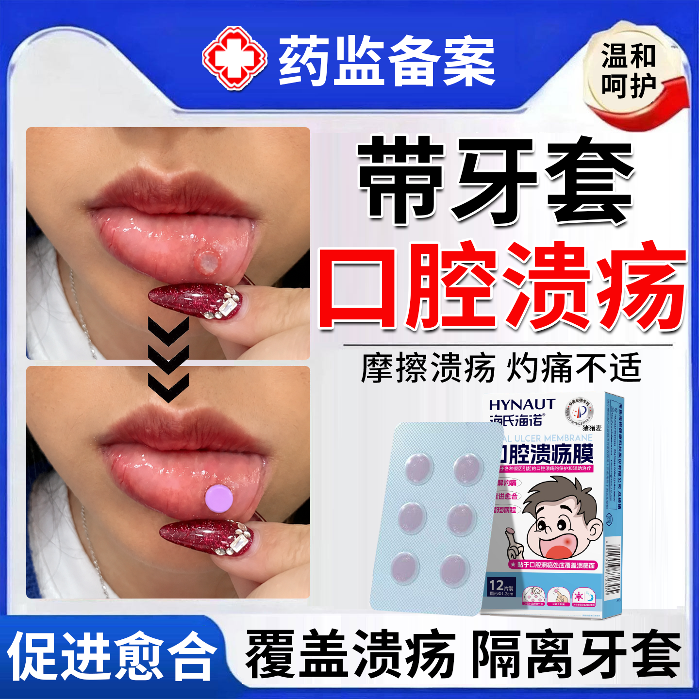 带牙套正畸口腔溃疡贴片膜防磨嘴隔离促愈儿童口舌生疮起泡专用BS