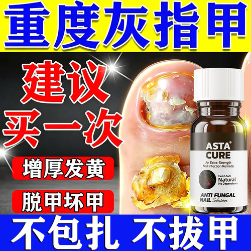 灰指甲专用药灰指甲抑菌液第一名正品旗舰店阿莫罗芬搽剂亮甲进口