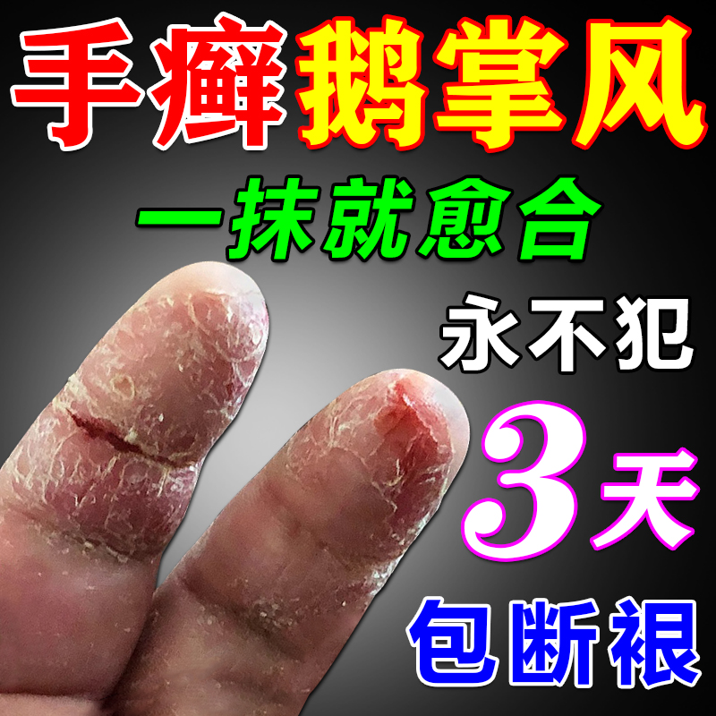 手癣膏脱皮干裂真菌感染治手足藓湿疹止痒抑菌手气根去专用特效药