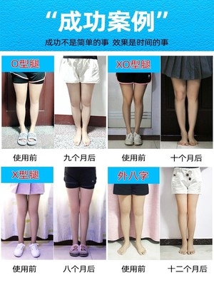 儿童足内翻膝内翻x腿o型腿矫正鞋垫胫骨内旋内八字外