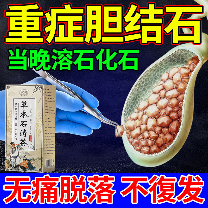 结石通茶九连山复方胆通片48片*1瓶/盒急慢性胆囊炎胆管炎胆道结