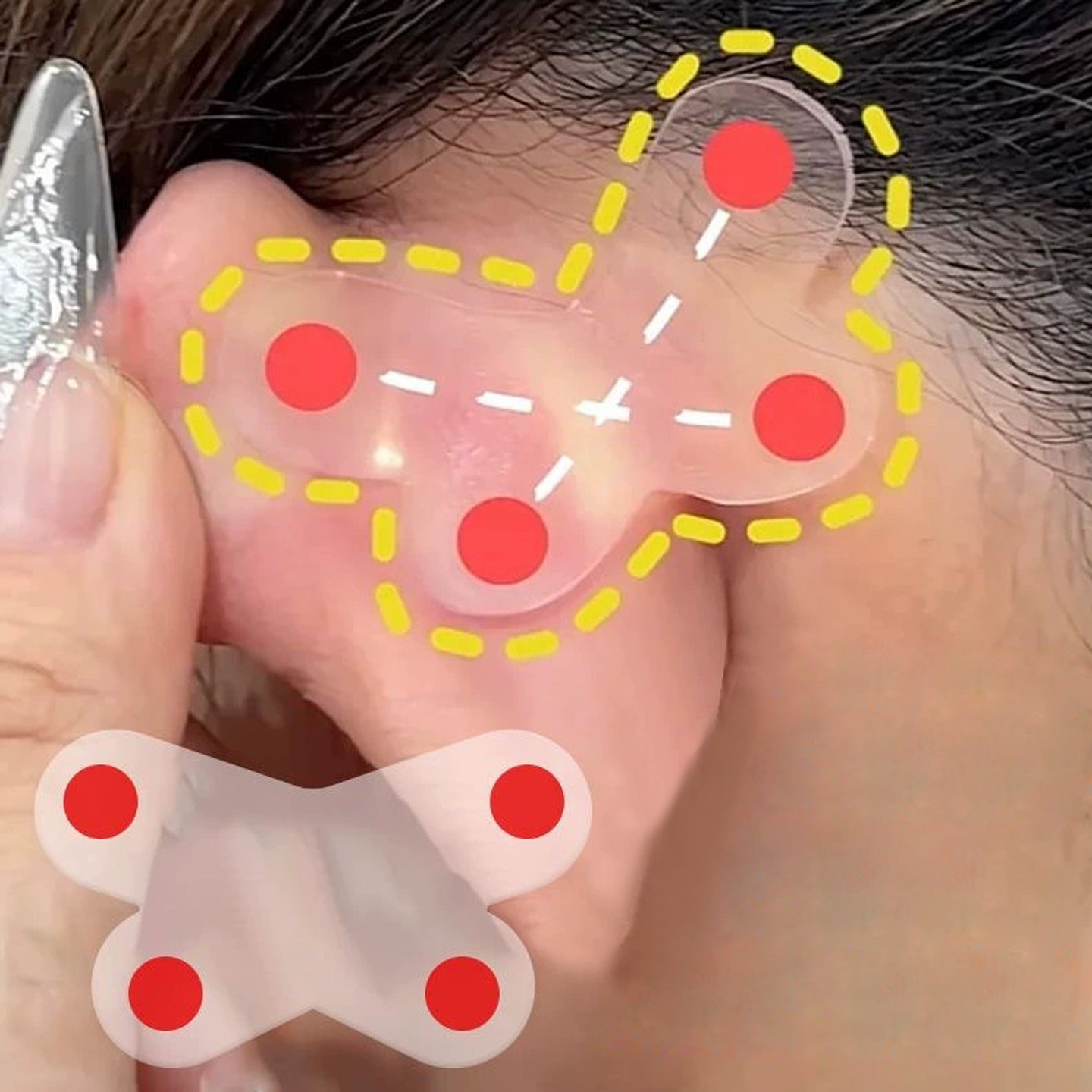 T耳贴/精灵B1zzn001-蝴蝶形支撑器女生固定招风耳立耳撑耳朵男女