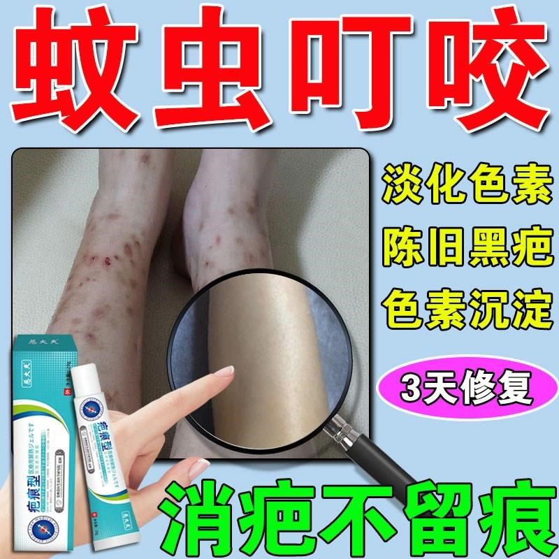 祛蚊虫叮咬疤膏去跳蚤蚊子叮咬疤痕腿上淡化黑色素修复腿挠印痘印